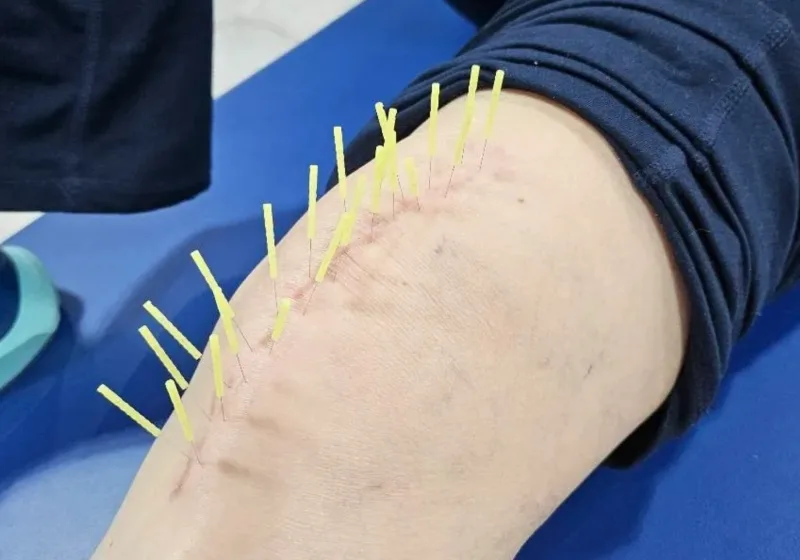Clinician performing dry needling trigger-point treatment