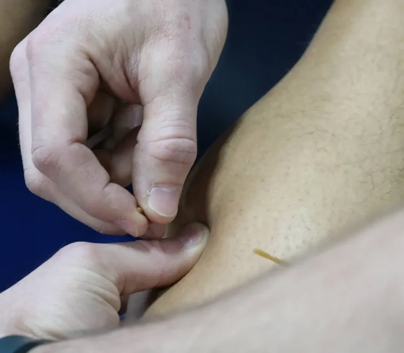 Clinician performing dry needling trigger-point treatment