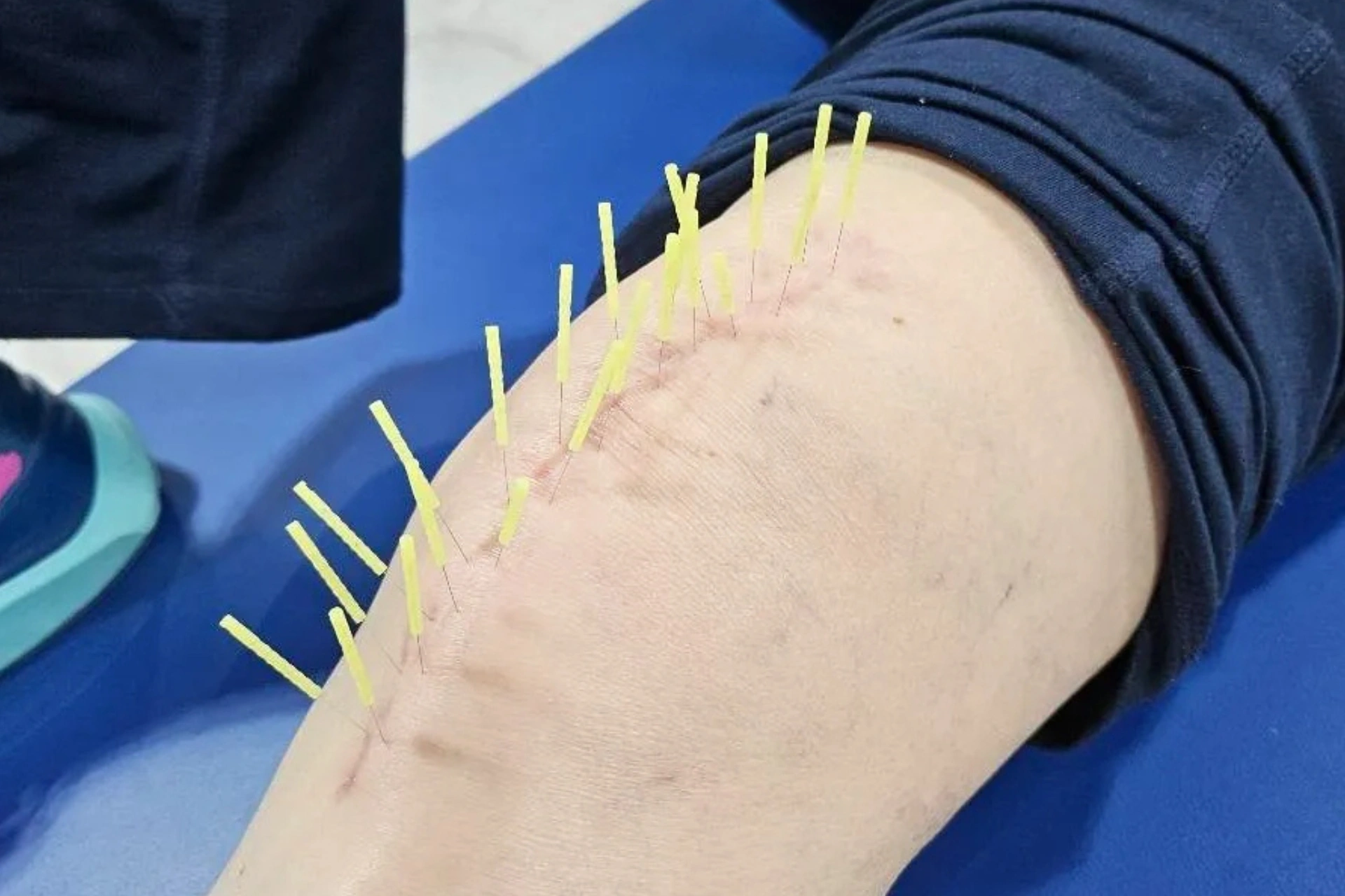 Dry needling san Antonio scar
